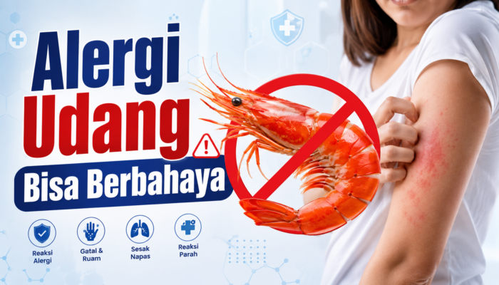 Alergi Udang Bisa Berbahaya, Ini Cara Mencegahnya Kambuh