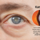 Katarak